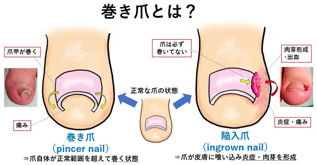 巻き爪と陥入爪